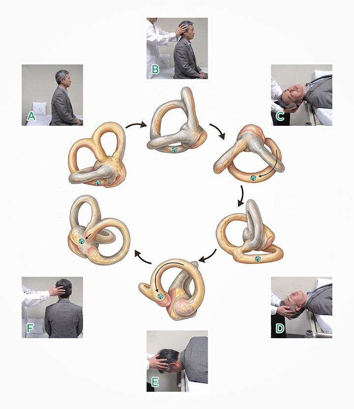 이석치환술