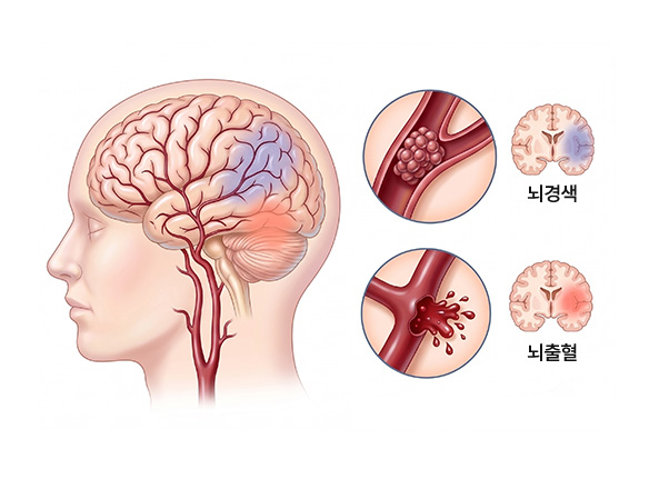 뇌혈관 질환